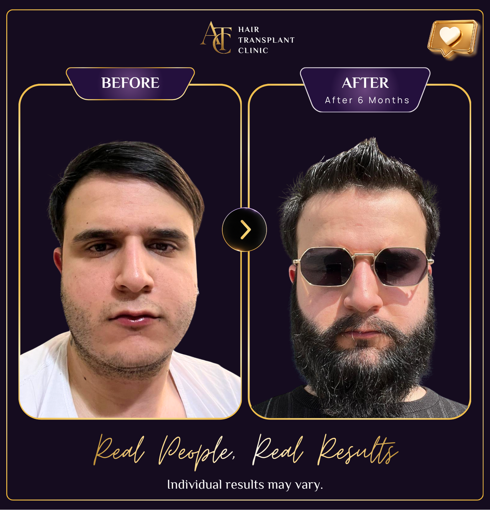 ATC beard transplant before and after