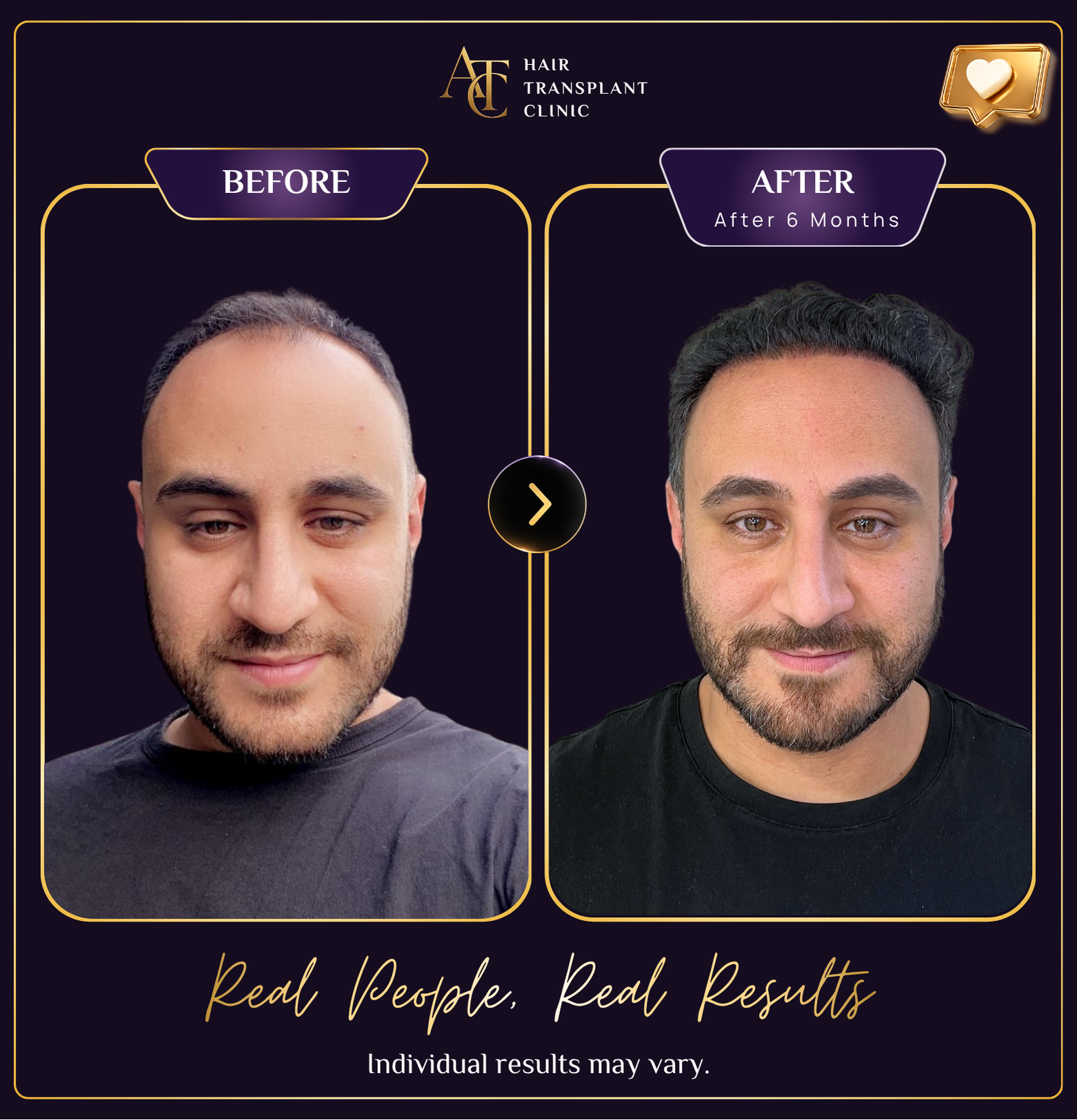 ATC frontal area and hairline before and after